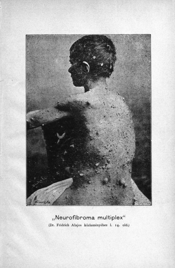 obr.č. 15 Ilustrácia príspevku A.Fridricha o neurofibróze (1891/92) 4.14 Zápal pľúc Medzi často diskutované otázky patrila liečba zápalu pľúc.