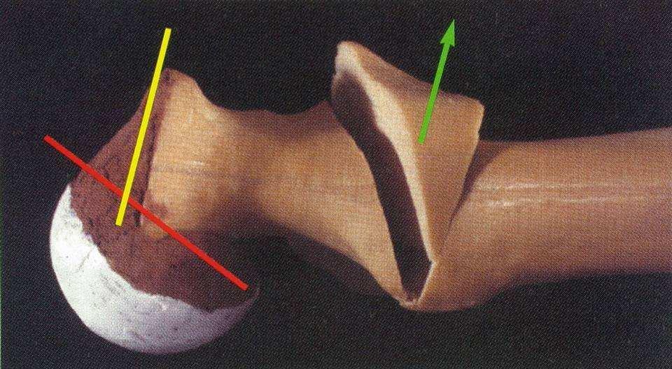 Southwick triplanáris