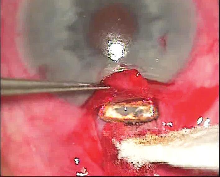 táblázat A szemnyomásértékek időbeli alakulása Vizsgált időszak Átlagos IOP ± SD p-érték Preoperatív (20 szem) 29,2 ± 9,4 Hgmm Posztoperatív első nap (20 szem) 10,6 ± 8,3 Hgmm 0,0000 Posztoperatív