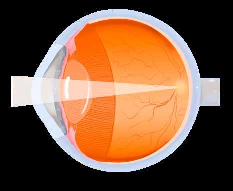 Mi a lézeres kezelés lényege? A szaruhártya a szem elülső átlátszó felszíne, itt lépnek be a fénysugarak a szemünkbe.