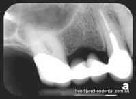 Csapos fogművek:: Klinikai korona hiánya: Caries Endodonciai kezelés