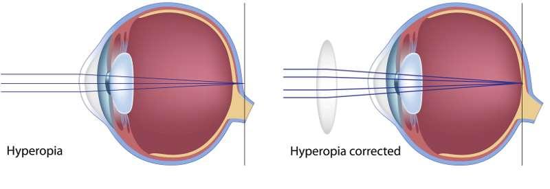 Binokuláris Binokuláris eltérés: a két szem kissé eltérő nézőpontjából adódóan ugyanannak a tárgynak a retinaképe a két szemben enyhén eltér. Minél közelebb van a tárgy annál nagyobb az eltérés.
