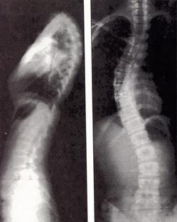 3 A strukturális scoliosis bármely életkorban kialakulhat. Minél korábban jelentkezik, várhatóan annál nagyobb lesz a végleges nagysága a növekedés befejeződésekor.