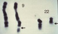 Egyszer volt, hol nem volt Janet Rowley h kromoszóma analízise A hiladelphia kromoszóma a 9-es