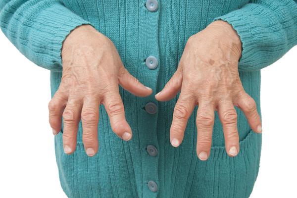 Rheumatoid arthritis RA alakul ki ha a szervezet hibásan saját szövetei ellen termel autoantitestet. Ez egy chronikus gyulladásos betegség, mely nemcsak a beteg izületeit támadja meg.