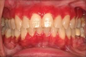 Desquamativ gingivitis A gingiva desquamatiója egy klinikai tünet, melyben az iny vörös, kisimult, károsodott.