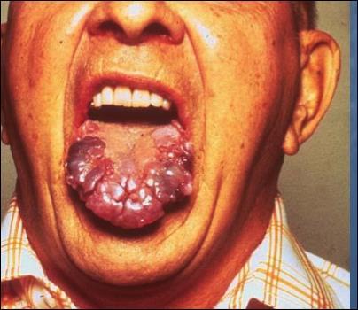 Hypothyreoidizmus A fogak késői áttörése A tejfogak expholiatioja Macroglossia Vastag