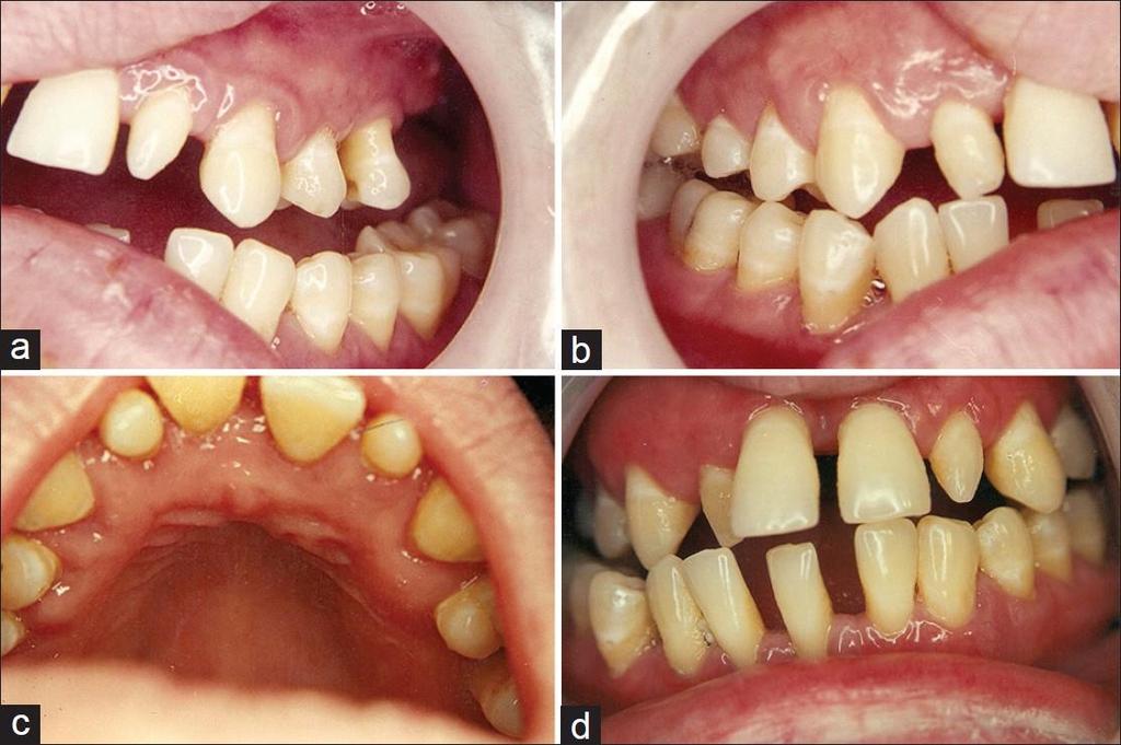 A hypoparathyreoidizmus fogászati menifestációja Dentalis