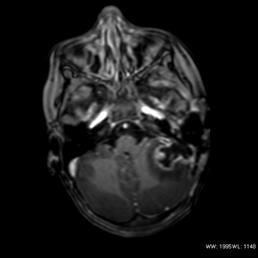 Amennyiben a körülmények miatt MRI vizsgálatot nem tudunk végezni, kontrasztanyagos koponya CT vizsgálatot kell készíteni.