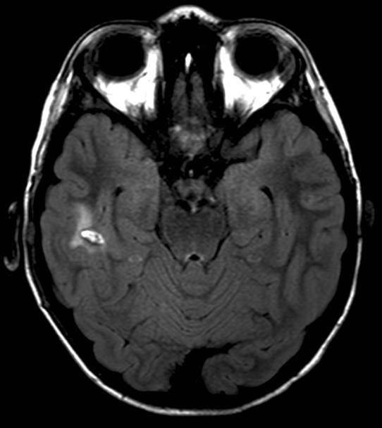 18. ábra Koponya MRI FLAIR T1+C vénás infarktus Koponya MRI+MRV (n:13) Mastoiditis 13 SS+ST+VIJ thrombosis 8 Csak SS