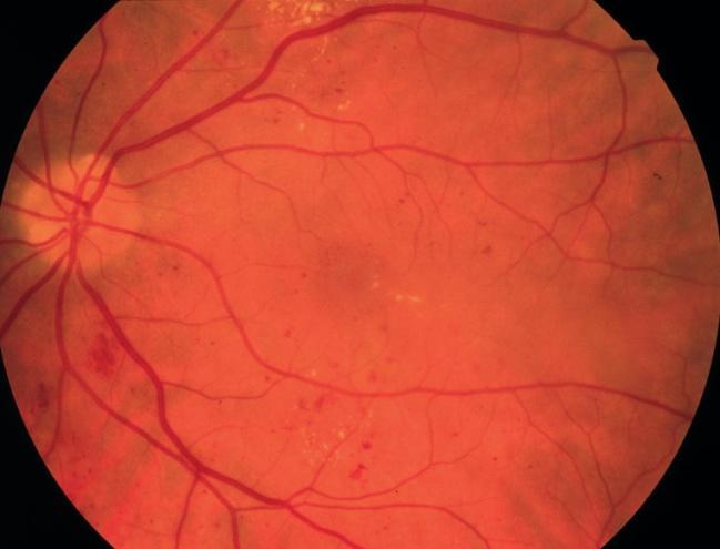 3. Háttér és irodalmi áttekintés 6. ábra Nem proliferatív retinopathia diabetica. Pontszerü vérzések, microaneurismák, kemény exsudátumok.