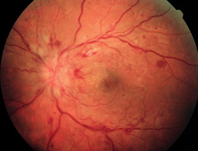 3. Háttér és irodalmi áttekintés (2) A diffúz macula oedemára jellemzőek az intraretinális capillaris eltérések (abnormalitások), amelynek következménye a diffúz folyadék kilépés.