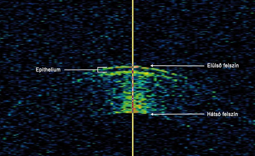 5. Módszerek cornea elülső és hátsó felszíne a környeztükből leginkább kiemelkedő, magasan reflektív maximumpontként nagyon pontosan azonosítható volt (17. ábra).