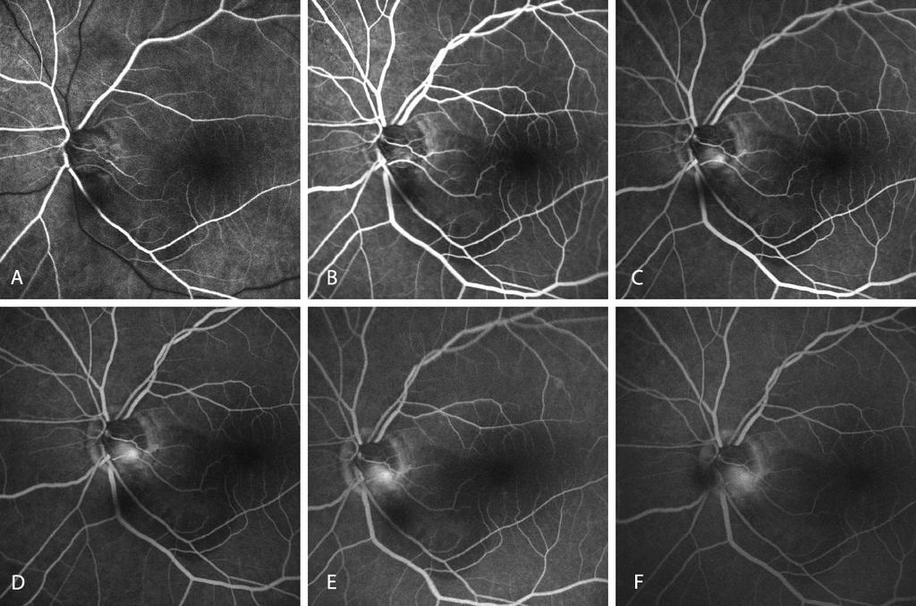 6. Eredmények 6.2. Optic pit maculopathia háromdimenziós rekonstrukciója (esetbemutatás) Az első vizsgálatot követően egy hónappal, a beteg kontrollvizsgálatánál a vízus 0.16-ra (20/125) csökkent.