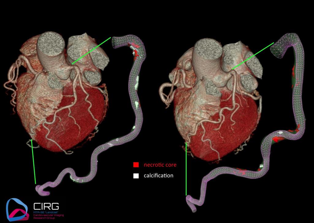 Coronaria atherosclerosis Tényleg 100%-ban egyezik az