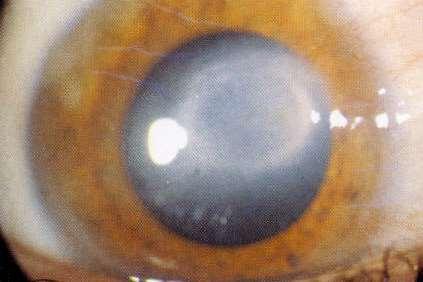 Keratitis disciformis Szubjektív tünete a látásromlás. Objektív tünete: korong alakú stromahomály, amelynek területében a stroma oedémás, duzzadt.