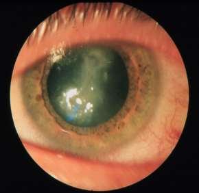 Keratitis metaherpetica Az epithelialis bazálmembrán károsodása miatt csökken az epithelium tapadása.