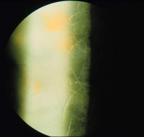 Lang GK: Ophthalmology, Thieme