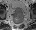 Méhnyak tumor