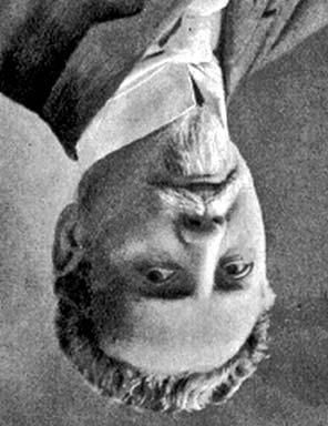 DR. BARTOS GÁBOR ÉS MTSAI. 0. ábra. A. temporalis profunda álaneurysma. ábra. Dollinger Gyula (849 937) profunda eredése alatt. Végtagelhalás miatt lábszáramputáció történt. 3.