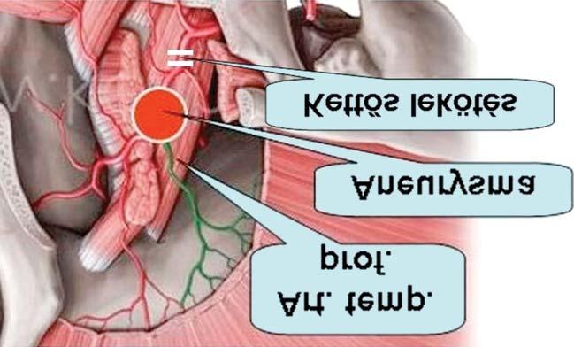 A gluteális izmok között tályogot, alatta pedig lúdtojásnyi aneurysmát találtak, amely az arteria profunda femoris (?) lekötésére összeesett. 4.