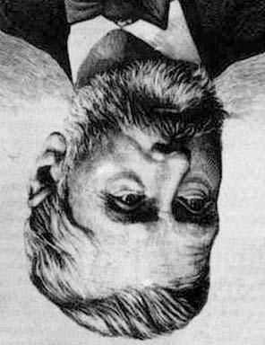 MAGÁNYOS FARKASOK I. 2. ábra. Markusovszky Lajos (85-893) proximalis arteria femoralis ligaturát végzett gyógyulással. Most a bal térdalji árokban észleltek aneurysmát.