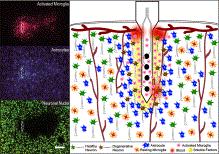 épített elektródok körül Parkinson s disease, Alzheimer s disease, cluster