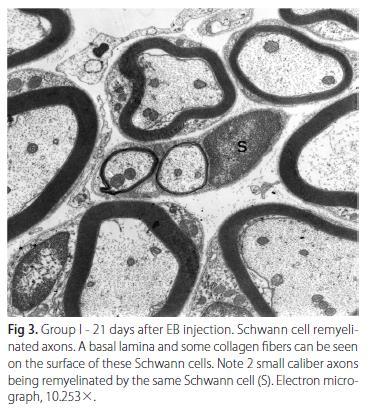 Wallerian degeneration PNS 3.