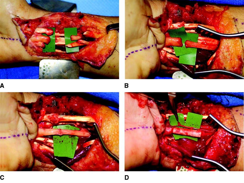 Intraoperatív képek, perifériás idegsérülés Glia- patofiziológia Wallerian degeneration PNS Kang, Zamorano, Gupta 2011 A, Több ín és egy ideg