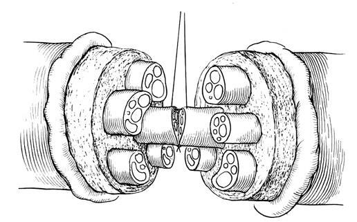 Epineural