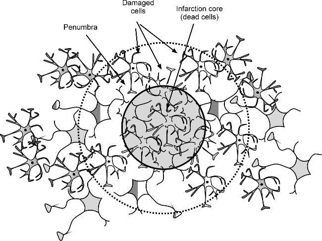 ischaemiás stroke - lokális véráramlás gátolt: ez infarktushoz vezet penumbra = ischaemic boundary zone (IBZ) core: 1 ml/g/min alatt;