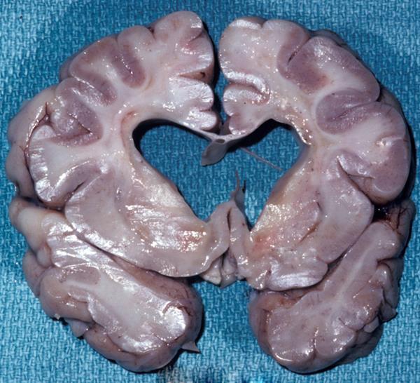 Alexander s disease, AxD 1949, Stewart Alexander astroglial disease!