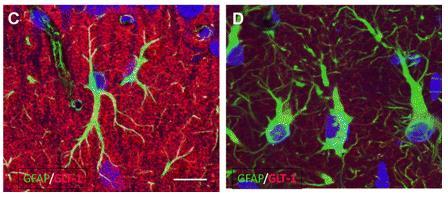 Rosenthal rostok asztrocitákban: GFAP overexpresszió és GFAP + stressz fehérjék (a,b-crystallin, hsp27) asszociáció izom-merevség, görcsök - ok: GFAP mis-sense mutációja, többnyire de novo mutáció,