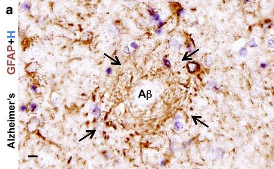 Alzheimer s disease Atrophy-note wide sulci caused by narrowed [lost tissue] gyri The figure above shows a