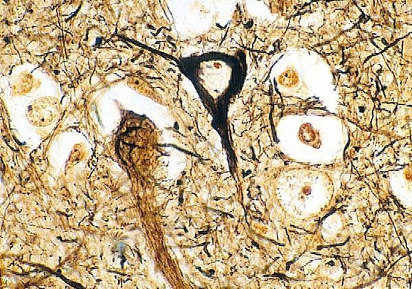 amyloid senile plaque with a pale unstained center (Aβ) ringed by dense layers of reactive astrocytic