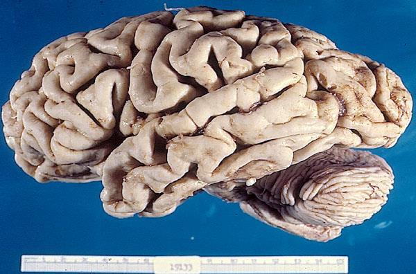 http://www.alz.org/braintour/healthy_vs_alzheimers.asp http://www.pathology.vcu.