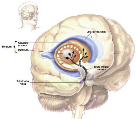 Parkinson s disease - mikroglia aktiváció és reaktív gliózis az érintett területeken, főleg substantia nigra (SN) ban - SN neuronok nagyon érzékenyek mikroglia aktivációra: talán ez kórok is