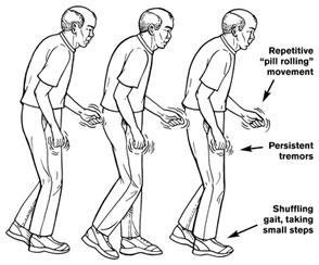 ? - valószínűleg asztro aktiváció csak másodlagos itt Parkinson s disease (PD) is a progressive neurodegenerative movement disorder characterized by degeneration of dopaminergic neurons in the