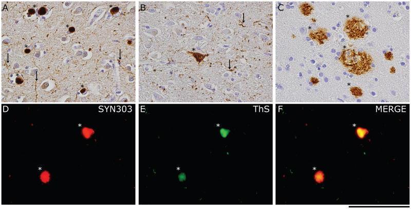 Parkinson s disease/alzheimer s Neuropathology of PDDThe main neuropathological features of PDD include: a) a severe burden of Lewy bodies (asterisks) and Lewy neurites (arrows) in the mid-frontal