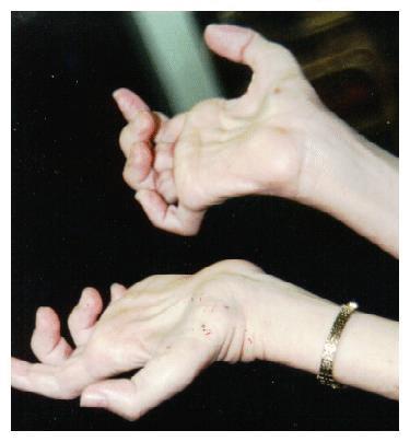 Charcot-Marie-Tooth disease (CMT)