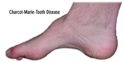 org/disease/charcot-marie-tooth/signs-andsymptoms