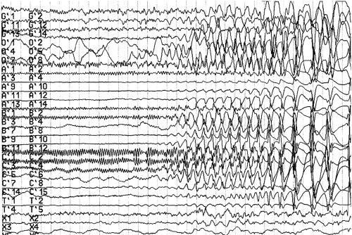 Epilepszia Neuronális hálózatok abnormális szinkronizálódása ( hypersynchronous neuronal activity ), mikor sok neuron egyszerre tüzel az epilepsziás gócban. Krónikus neurológiai rendellenesség.