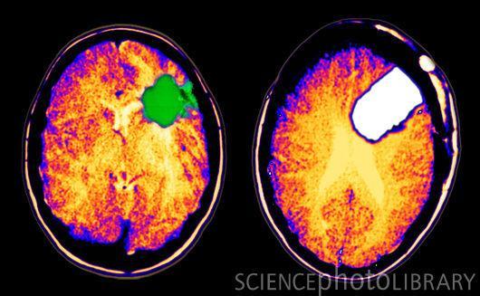 Gliomák glioma sejtek jól migrálnak agyszövetben, akár a másik féltekébe is: - metalloproteináz expresszió - morfológiájuk könnyen változik,