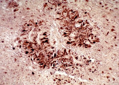 glioma motilitása csökken - glioma migrációt Ca ++ permeábilis AMPAR is mediálják, ezek gátlása is csökkenti tumor növekedését CT scan of brain