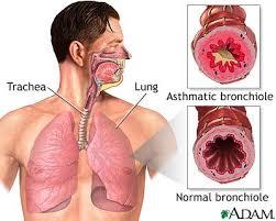 Asthma bronchiale A tüdő bronchusainak görcsét jelenti, ez váltjai ki a betegnél a fulladásérzést, és az elégtelen oxigénellátást.