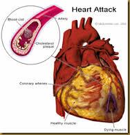 Infarktus A koronária erek elzáródását és a mögöttes terület elhalását