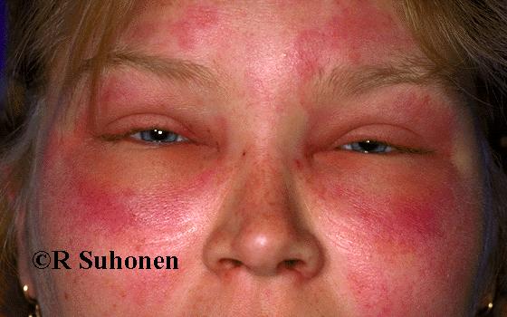 Allergia Szervezet reakciója egy külső allergiát okozó anyaggal szemben.