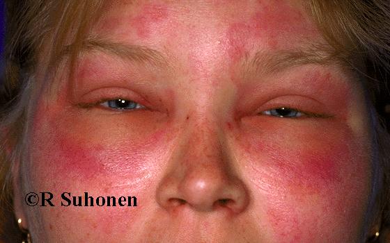 Allergia Szervezet reakciója egy külső allergiát okozó anyaggal szemben.
