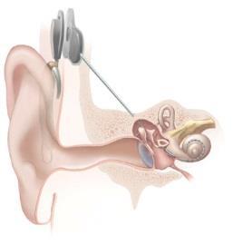 A hallási észlelés helyettesítése: a cochleáris implantáció A siketek nagy részénél a probléma forrása a