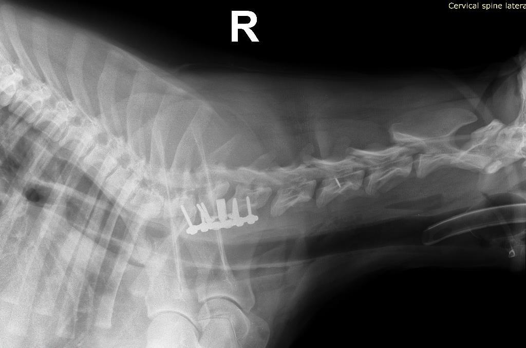 8. ábra: Postoperatív röntgenfelvétel, Ares Látható a C6-7-es csigolyaközbe helyezett távtartó, a szögstabil lemez, illetve a tágult csigolya közötti rés.